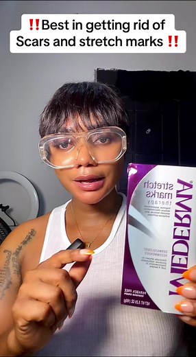 Effective Stretch Marks Removal Tips and Recommendations | Consult Now