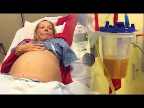 how to perform an abdominal fluid drainage procedure - Nurse Practitioner Student Mrs Starr