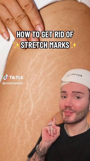 Effective Ways to Remove Stretch Marks