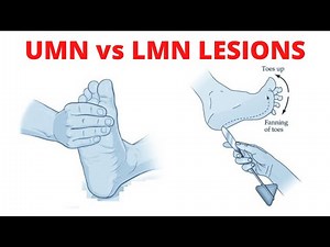 UMN vs LMN Lesion