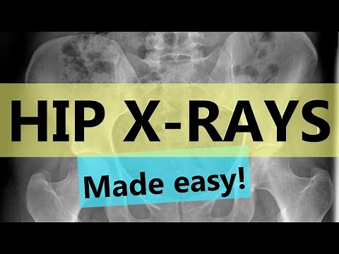 How to read hip x-rays | EASY GUIDE
