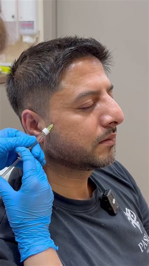 Full face filler volumization