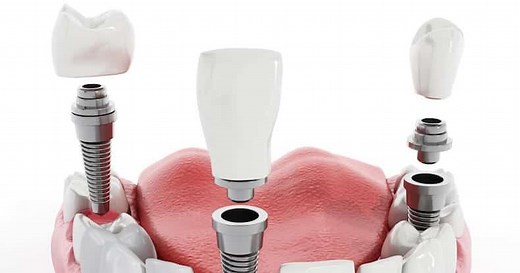 Dental Implant Insurance: Plans and Prices - Dentaly.org