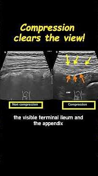 Graded Compression Technique in Ultrasound