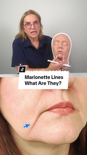 Have you heard of Marionette Lines? In this video, I tell you all about them, how they affect your face and what options we have to minimize their appearance. Hint: it’s not lip fillers. Share this video with someone who needs it! #marionettelines #aging #theagingface #treatment #wrinkles #botox #neuromodulators #neurotoxins #smoothskin #beautyindustry #beautyproducts #skinroutine #acne #acnebreakout #acnetreatment #explained #injectables #health #beauty #skincare #nursetrainer