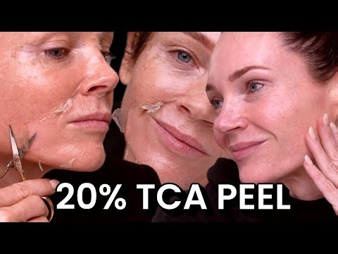 I Cleared a 20% TCA Peel in 6 Days | Full Frost, Full Peel, Full Results