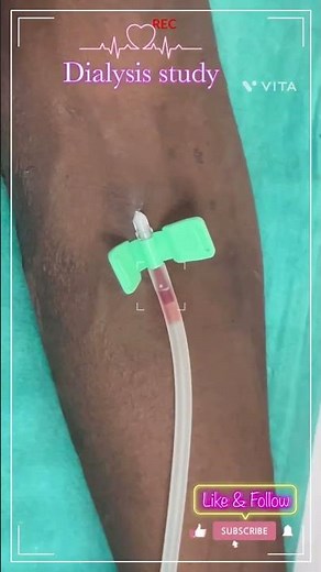AV Fistula Cannulation Technique | How to Cannulate an AV Fisltula #dialysis-study #dialysis