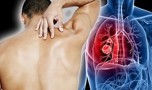 Lung cancer: Signs and symptoms to look out for
