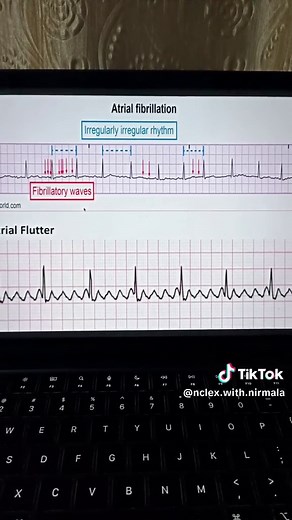 Artial Arrhythmia 1) Atrial flutter 2)Atrial fibrillation #nclexwithnirmala #nclexstudying #cardioweek #fyp #goviral
