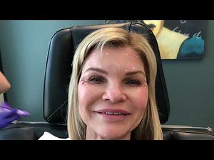 Botox injection full demonstration