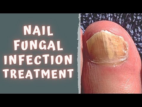 HOW TO TREAT FUNGAL NAIL INFECTION - TINEA UNGUIUM / ONYCHOMYCOSIS