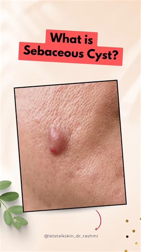Dr Rashmi Biradar on Instagram: "Do you have a small lump under the skin that has been there for months or even years? A sebaceous cyst is a common, non-cancerous skin condition that may slowly grow over time. It can remain painless, or sometimes become painful, inflamed, or infected if ignored or repeatedly squeezed. Sebaceous cysts can appear on the face, scalp, neck, back, or other body parts. Trying to pop or treat them at home can lead to infection, rupture, and scarring. Proper dermatologi