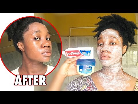 I APPLIED COLGATE TOOTHPASTE & VASELINE TO MY FACE AND LOOK WHAT HAPPENED AFTER!