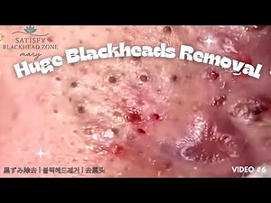 Rare Full Face Blackhead Removal | Huge Pore Extraction | Part 1 of 3 | Video 6
