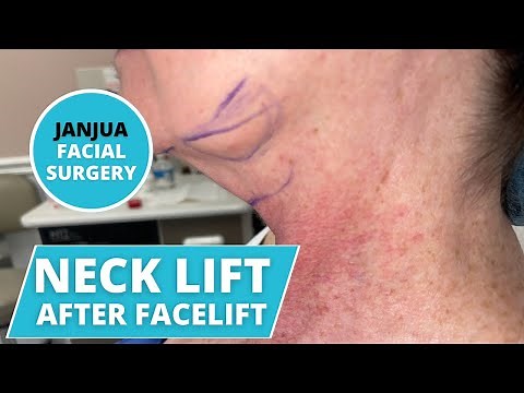 NECK LIFT (PLATYSMAPLASTY) AFTER FACELIFT - DR. TANVEER JANJUA - NEW JERSEY