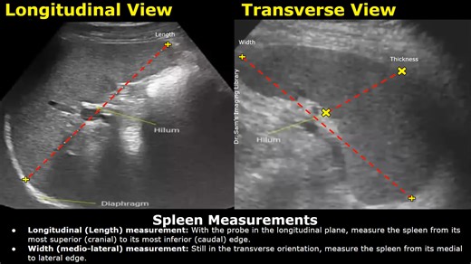 How To Measure The Spleen On Ultrasound | Splenic Length, Width, Thickness & Volume Measurements & Size USG Longitudinal (Length) measurement: With the probe in the longitudinal plane, measure the spleen from its most superior (cranial) to its most inferior (caudal) edge. Width (medio-lateral) measurement: Still in the transverse orientation, measure the spleen from its medial to lateral edge. Transverse (Thickness) measurement: Rotate the probe to a transverse orientation. Measure the spleen fr