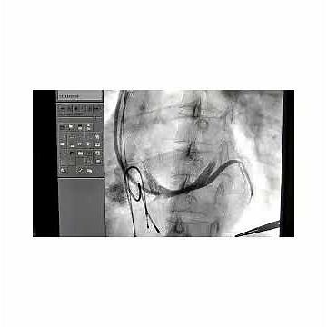 CRT D Implantation
