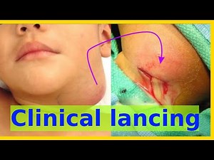 clinical lancing