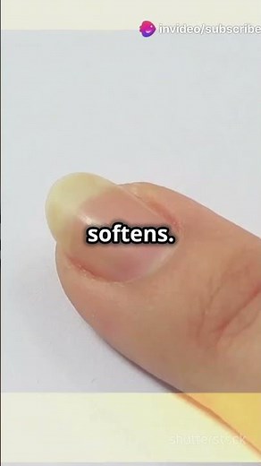 What is Finger Clubbing Causes & Degree