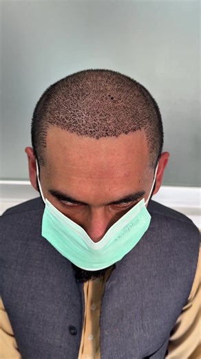Sapphire Fue Hair Transplant: A 15-Day Journey