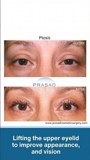 Drooping Eyelid Causes and Treatments #droopyeyelids