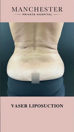 Vaser Liposuction Before and After Results by Mr Anuj Purbey