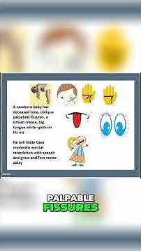 Down Syndrome: Symptoms, Signs, and Complications Explained #shorts