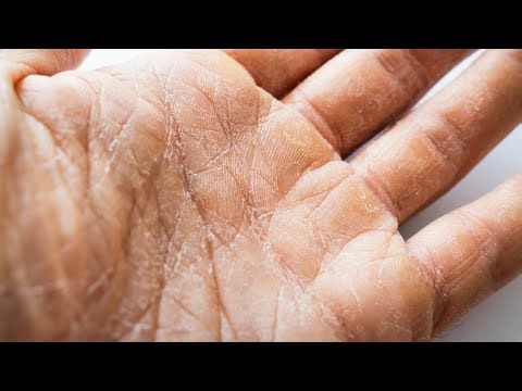 Dry Hands| Top 5 Moisturizing Remedies You Need to Try Now