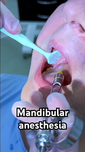 Mandibular anesthesia in dentistry during dental treatment #teeth #dentist #dental #cavity #dentista