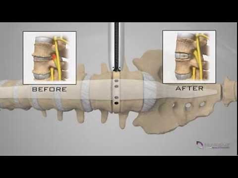 NuVasive® XLIF® Patient Animation