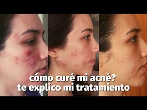 Acne quistico: Cómo me curé? Te explico mi tratamiento | Evolución con fotos, medicamentos, cremas