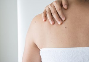 Mole Check / Screening