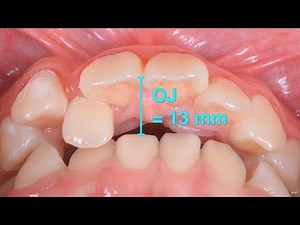 Excessive overjet with invisalign｜【Chris Chang Ortho】CC666
