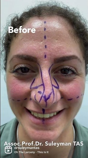 Crooked Nose Correction | Before & 7 Days After | Straightening Symmetry ✨