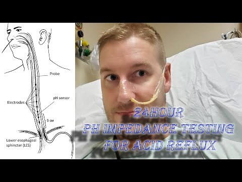 24hr PH Impedance Probe Testing for Acid Reflux and GERD Symptoms