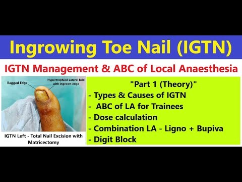 How to give Local Anesthesia, Digit Block- Ingrown Toenail (IGTN) Management 1/3) #ingrowingnail