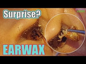 Earwax removal is entertaining, lots of surprises