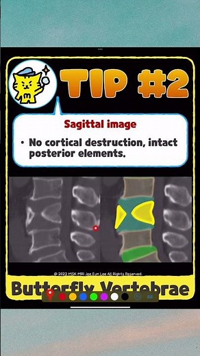📌Butterfly Vertebra: A Commonly Misdiagnosed Congenital Anomaly