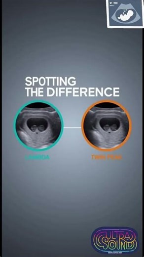 Twin pregnancy -lamda sign