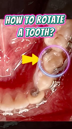 Rotate a Tooth with Braces (Couple Moment) 🔄