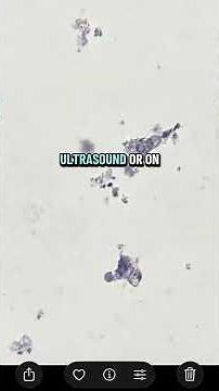 Explaining complete pathologic response #breastcancertreatment #breastcancer #chemotherapy