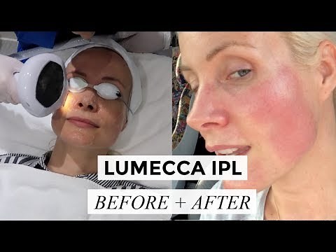 LUMECCA IPL : BEFORE + AFTER | Liv Judd