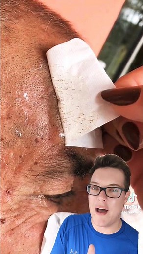 😱EXTREME BLACKHEADS REMOVAL (The Sun Caused These!) - Pore Strip Removal #shorts