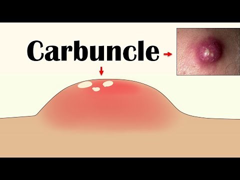 Carbuncle - Causes, Signs & Symptoms, Risk Factors, Diagnosis, & Treatment