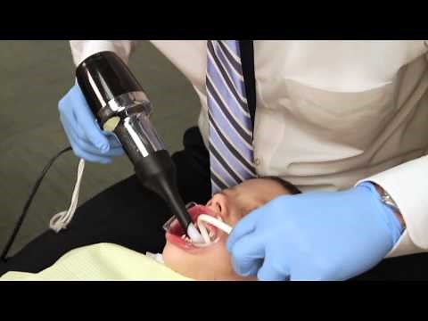 Rapid Palatal Expander Procedure Explained