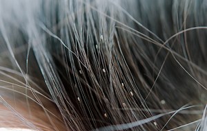 What Do Head Lice Look Like? (20 Close-Up Pictures) - Today's Homeowner