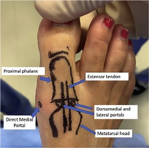 Needle Arthroscopy Cheilectomy for Hallux Rigidus in the Office Setting