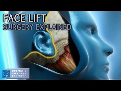 Facelift Surgery Explained - Cosmetic Surgery Video Animation