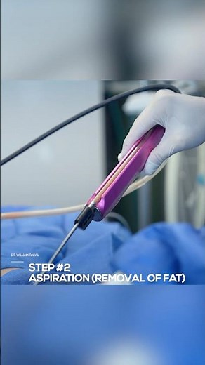 360 Liposuction: Your Ultimate Guide To Achieving The Perfect Hourglass Figure!