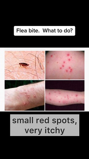 Flea bite. How to cure? Very dangerous insects. They bite painfully, leave red spots on the skin, are very itchy, and can transmit various diseases. #fleabag #flea #fleas #fleainfestation #flearemoval #fleabites